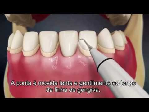 Destartarização Bimaxilar: Benefícios e Procedimentos Eficazes