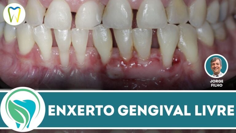 Preço do Enxerto Gengival em Portugal: Tudo o que Você Precisa Saber