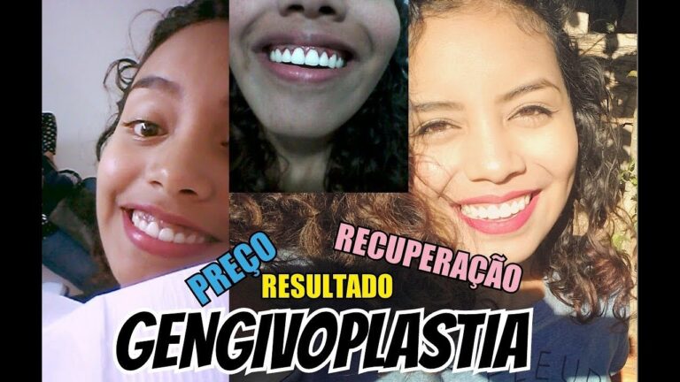 Gengivoplastia: Pre&ccedil;os e Op&ccedil;&otilde;es em Portugal