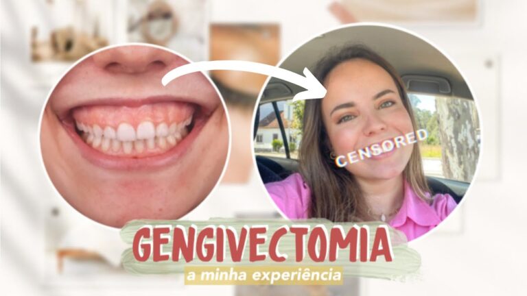 Gengivectomia: Entenda os Preços e Fatores que Influenciam