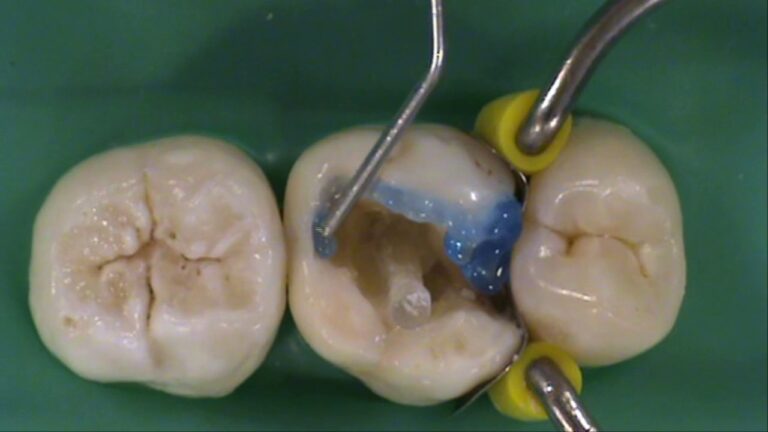 Espigão de Dente: Preços e Comparações